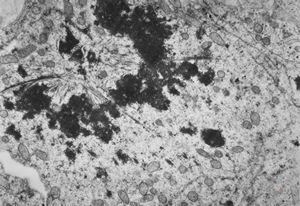 M,4y. | mitosis - retroperitoneal neuroblastoma